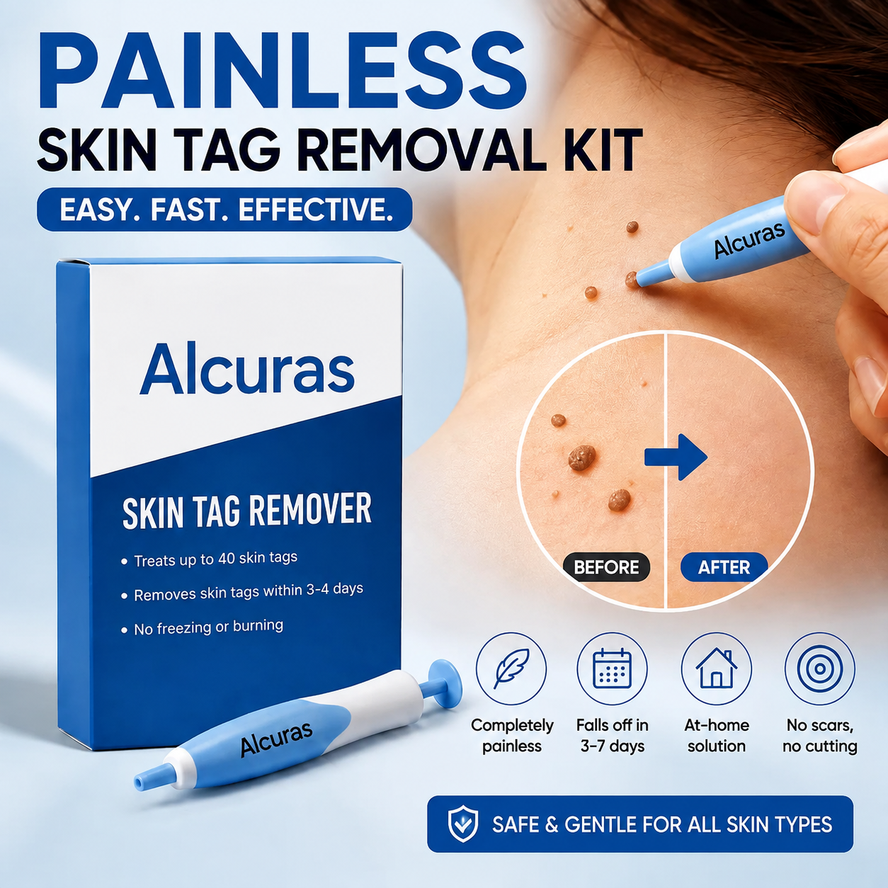 Painless Skin Tag Removal Kit - Safely Remove Skin Tags at Home